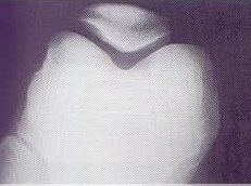 Posicionamiento Tangencial de Rótula